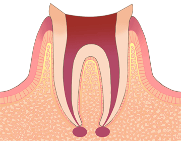 虫歯部分の削除