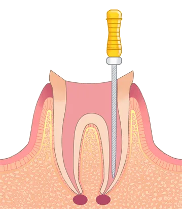 抜髄・洗浄・消毒