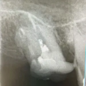 マイクロスコープを使い、破折ファイルを取り除いた画像です