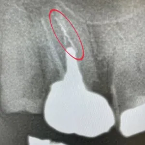 ⭕️部分が違和感の原因です。破折ファイルが残っていました。